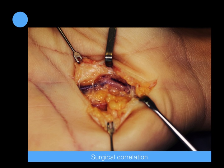 Figure 5 for case Hypothenar Hammer Syndrome